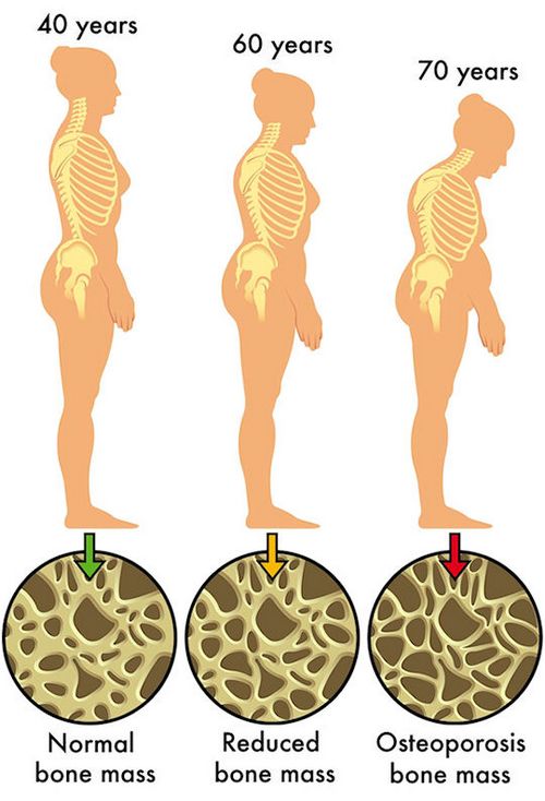 Apa itu Osteoporosis? tulang sangat