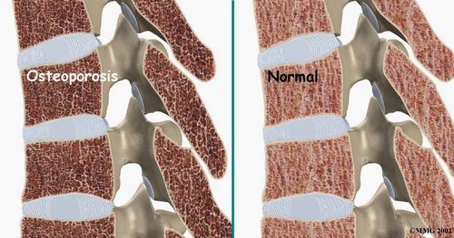 Apa itu Osteoporosis? kali diresepkan