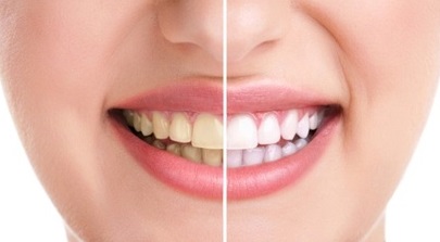 Dokter Gigi Umum dan Kosmetik: Yang Perlu Anda Ketahui lingual tersembunyi jika telah terjadi